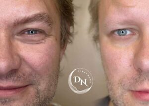 The photo illustrates a before-and-after transformation of a man's eyebrows using the hairstroke technique. Before the procedure, he appears without eyebrows. After the hairstroke technique, his eyebrows look natural and well-defined, with individual hair-like strokes enhancing their appearance. This PMU method provides a realistic and long-lasting enhancement, restoring a natural look to his brows.