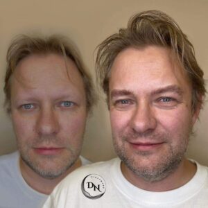 A before-and-after photo showing a man without eyebrows in the "before" image and with realistically recreated eyebrows using permanent makeup in the "after" image. The transformation highlights the natural look of the new eyebrows achieved through the cosmetic procedure.