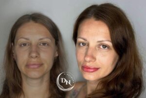 before-and-after photo of a lip blush procedure. See how asymmetrical lips are transformed into perfectly balanced, alluring features, showcasing the natural beauty of the woman's lips.